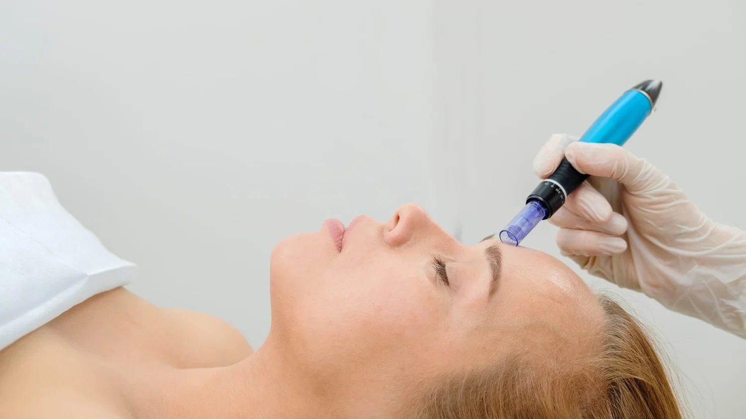Revitalize Your Skin: The Power of Microneedling with Exosomes