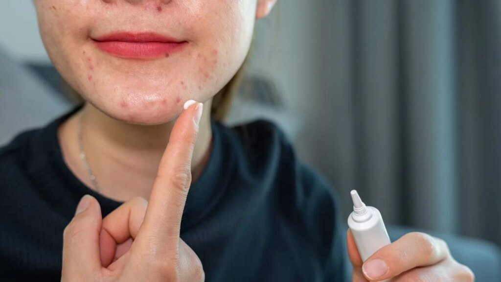 Ultimate Guide to Benzoyl Peroxide: Transform Your Skincare Routine