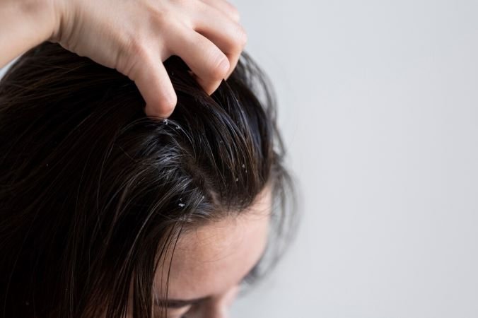 Eliminate Dandruff for Good: Proven Strategies for Flake-Free, Healthy Hair
